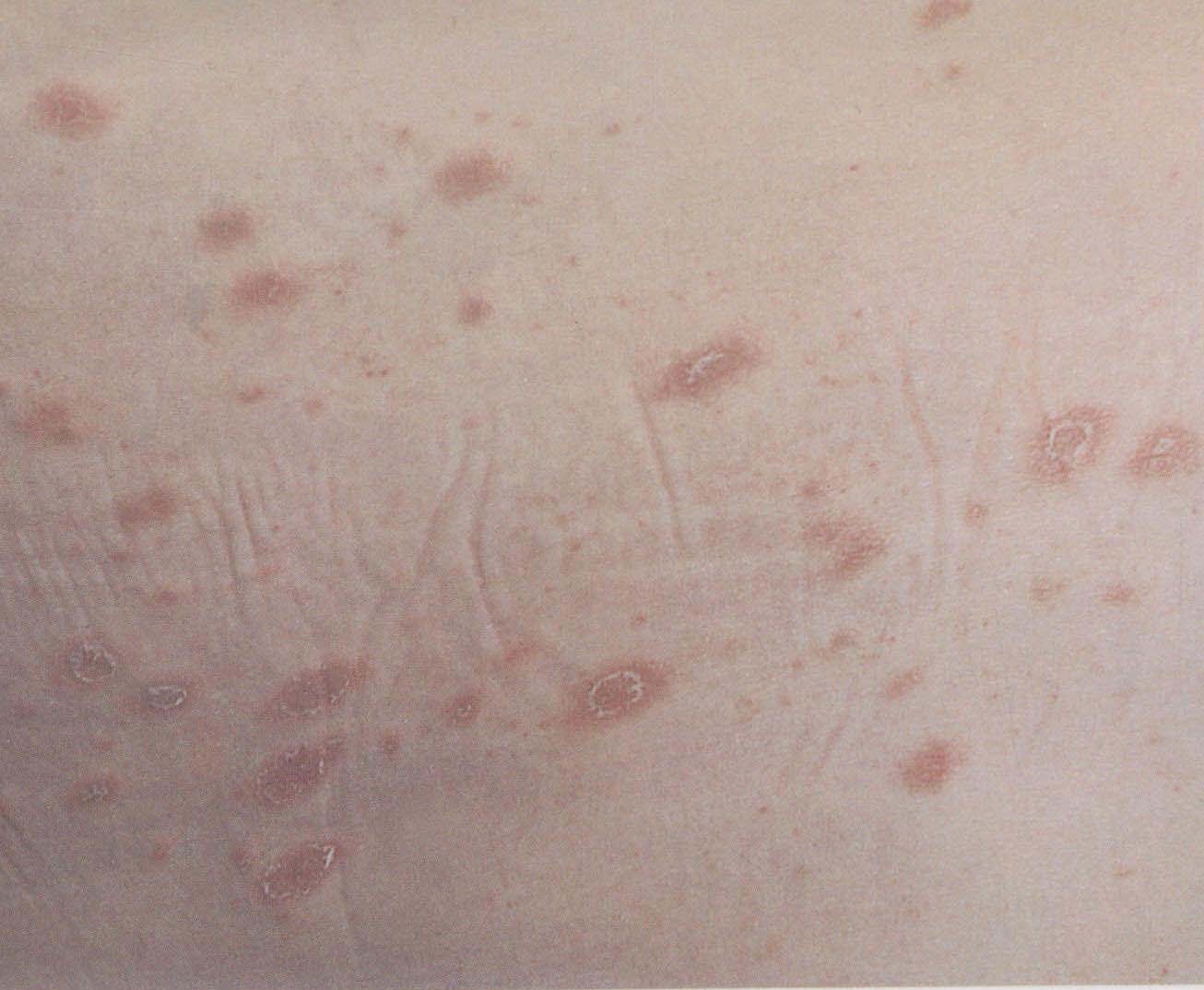 患者有丘疹样结节，皮肤科医生判断为丘疹性瘙痒
